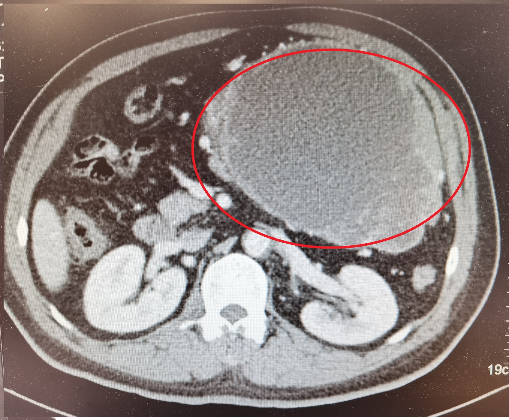 胃间质瘤23例,和胃间质瘤对抗的12年
