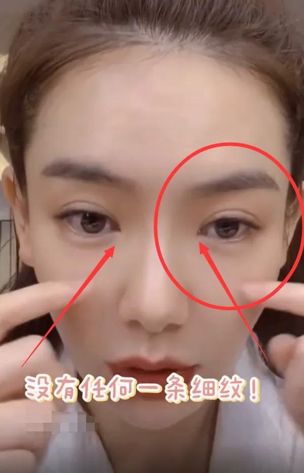 戚薇眼睛双眼皮前后,戚薇双眼皮前后对比照真实