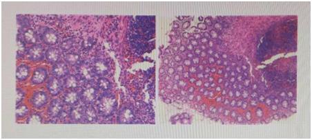直肠活检结果是慢性炎症怎么治疗,直肠粘膜炎性改变便秘怎么办