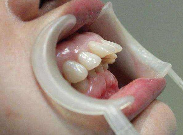 整齐的龅牙影响咬合,严重龅牙用隐形矫正有效果吗