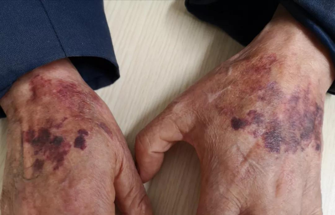 色素性紫癜性皮肤病是啥,色素性紫癜性皮肤病是什么