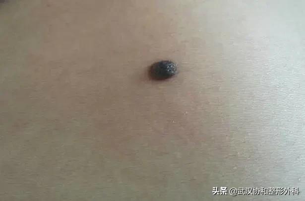 两毫米的痣医生要切,切痣医生怎么判断有没有切干净