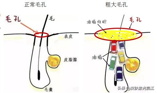 毛孔粗大5种类型改善方法,毛孔粗大程度分级
