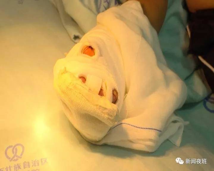 广西一3岁男童在路边玩不慎被石头砸断三根手指