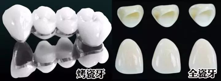 有蛀牙但没时间做根管怎么办,蛀牙多严重做根管