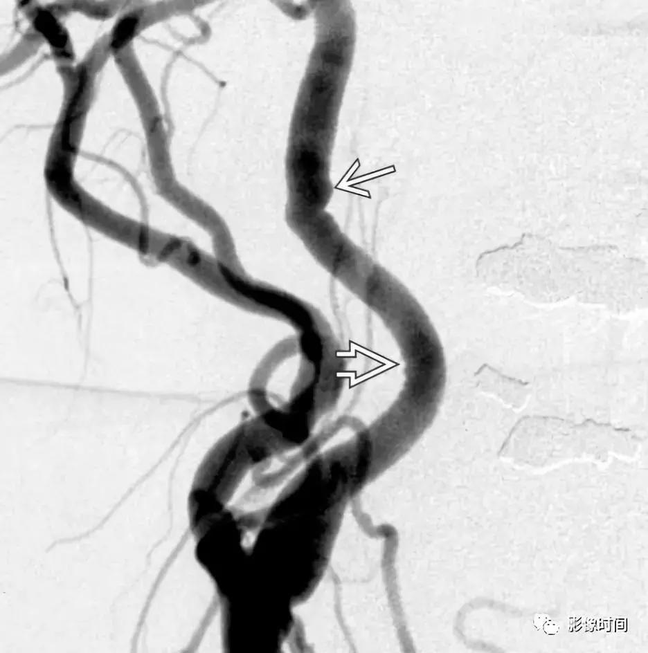 双侧颈动脉鞘间隙多发小淋巴结影,双侧颈动脉间隙多软组织密度结节