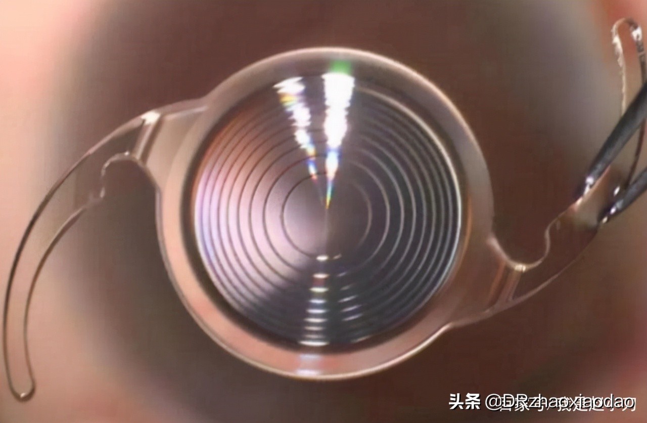 白内障手术人工晶体选择,白内障手术人工晶体是怎么做的