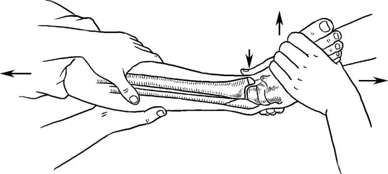 骨折闭合复位髓内钉内固定术,骨折闭合复位
