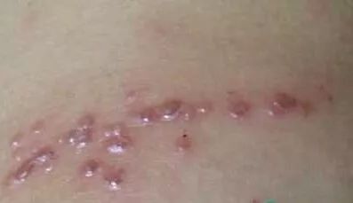 孩子得了水痘怎么办啊,成年人得了水痘痛不欲生