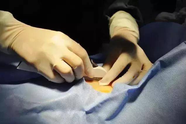 皮下埋置避孕是新技术吗,最新避孕方法皮下埋植