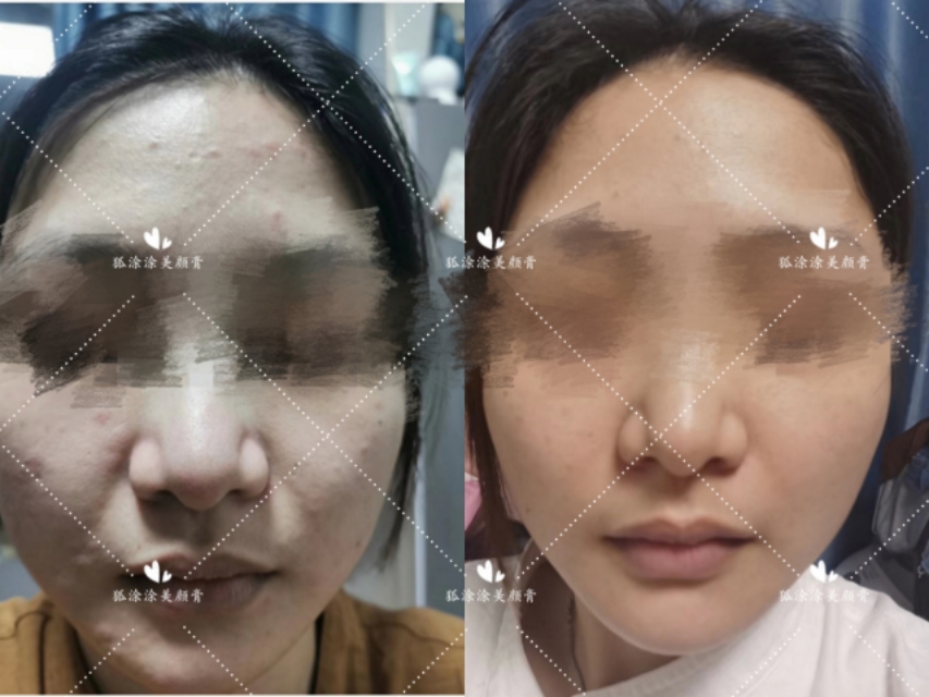 祛痘印痘坑用什么产品最好,什么产品祛痘印和祛痘最好最快