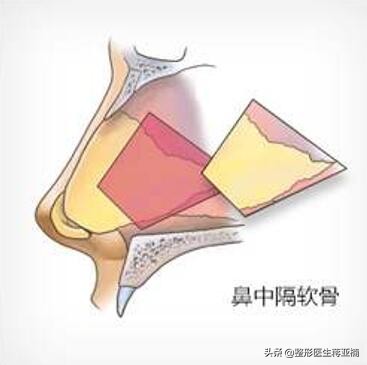 所有的耳软骨隆鼻都是假假体的么,辟谣整形传闻