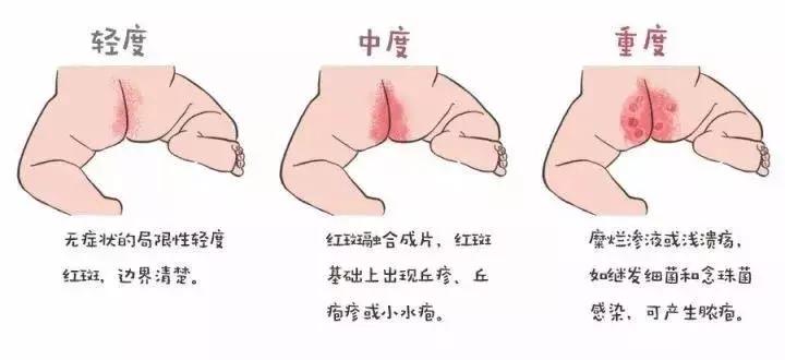 我儿子屁股上破了两个洞，做家长的真是一刻都不能放松