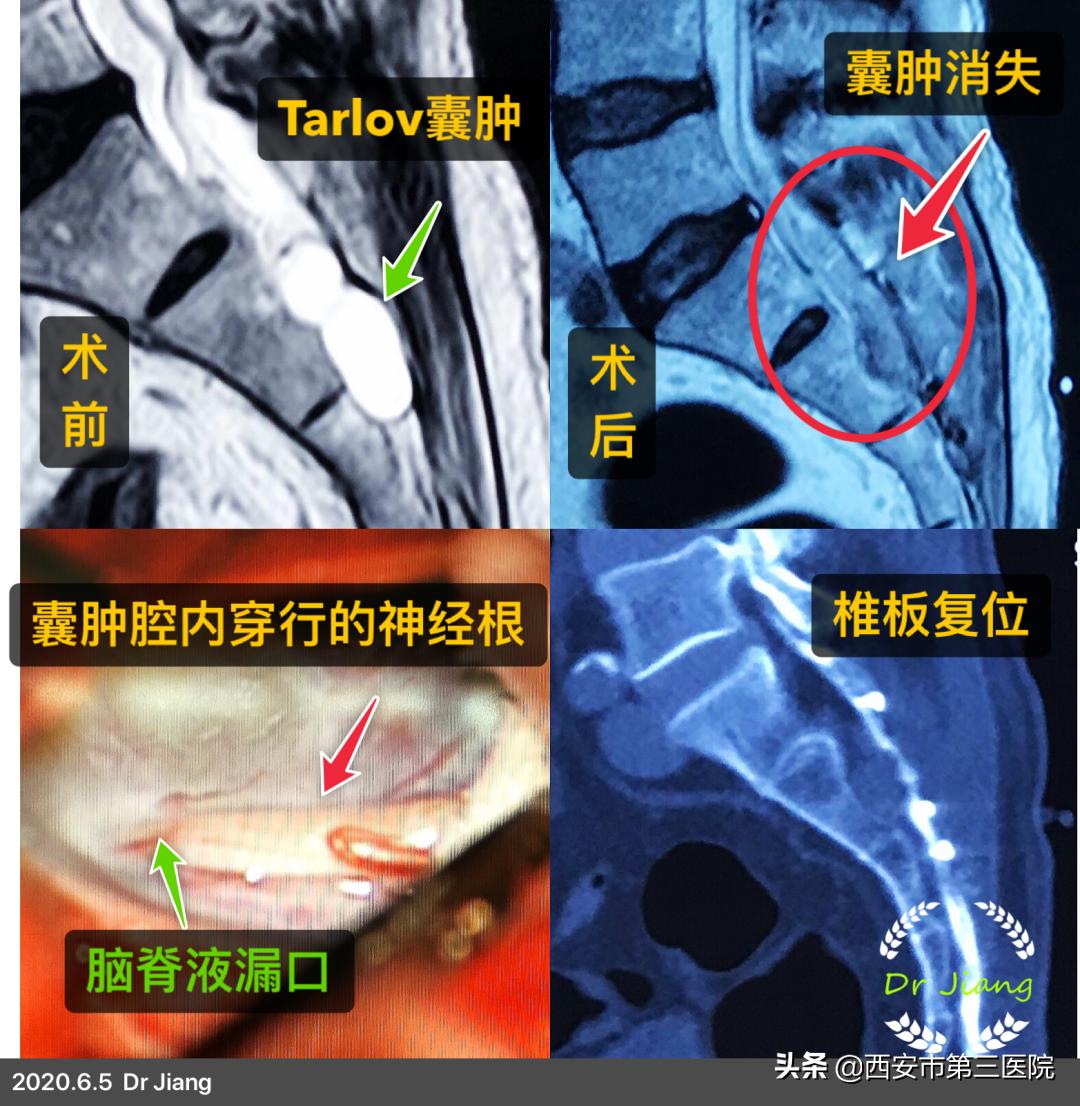 【医者解读】揭开“骶管囊肿”之神秘面纱，查出骶管囊肿都需要治疗吗？（手术病例+文献回顾）