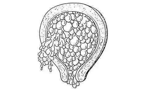 什么是葡萄胎？准妈妈怎样尽早发现？