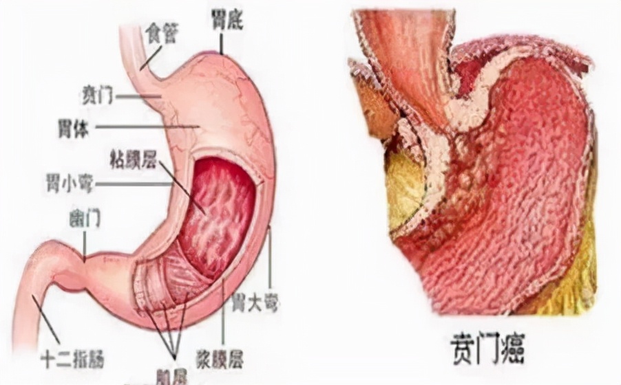 真牛！龙港医院治愈一癌症患者