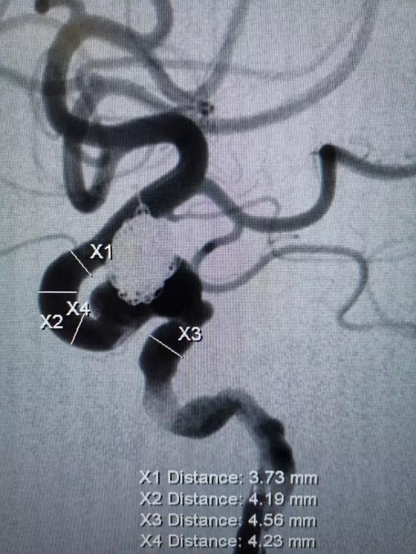 山东大学齐鲁医院王东海教授团队成功治疗多发性动脉瘤