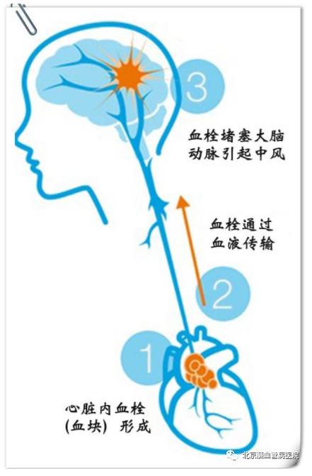 老年人脑梗塞康复锻炼方法,脑梗塞锻炼走路视频大全