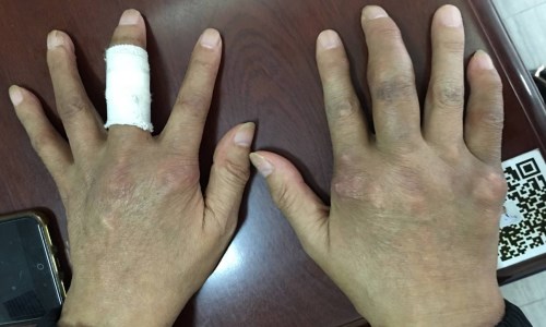 痛风十年有痛风石怎么治疗,痛风石治愈成功案例