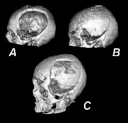 自体颅骨修补颅骨流失的几率大吗,颅骨缺损不修补的危害