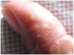 宝宝手指脱皮怎么办,夏天手指脱皮怎么办