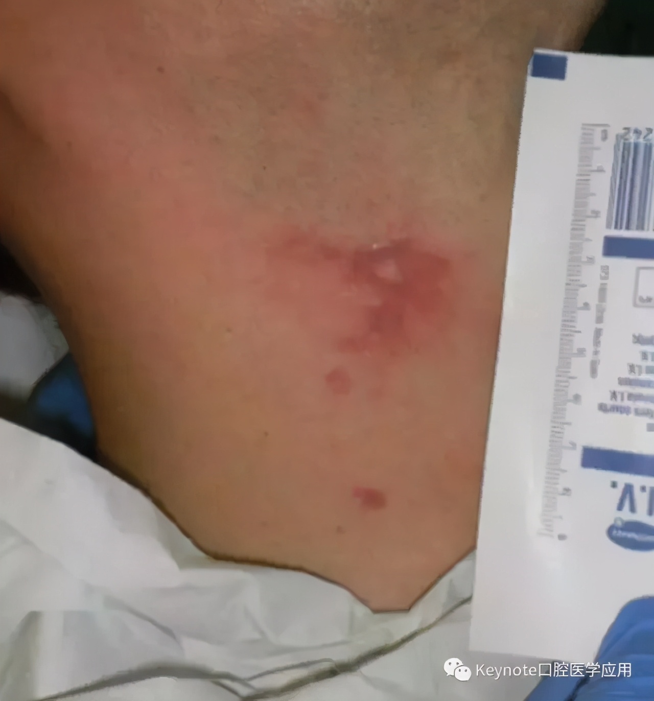 氢氟酸的危害有多可怕,氢氟酸的危害到底有多大