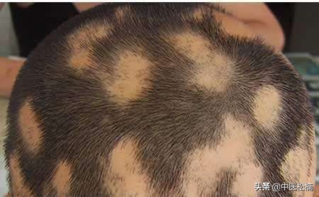 中医斑秃的主要病因是什么,斑秃中医辨证
