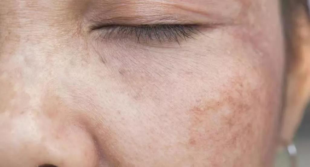 褐斑怎么治疗最有效,褐斑怎么治才能除根