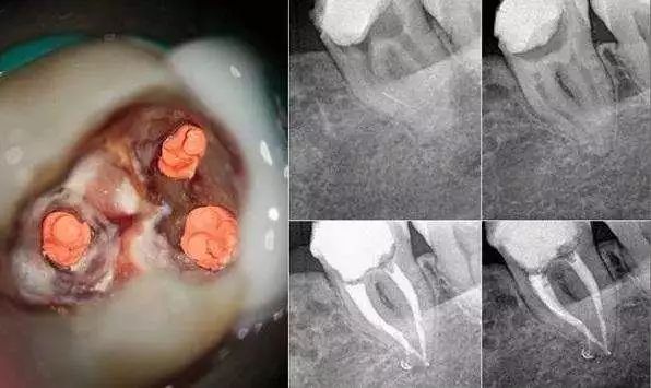 已经有牙洞了怎么根管治疗,牙髓腐烂坏死再做根管治疗会痛吗