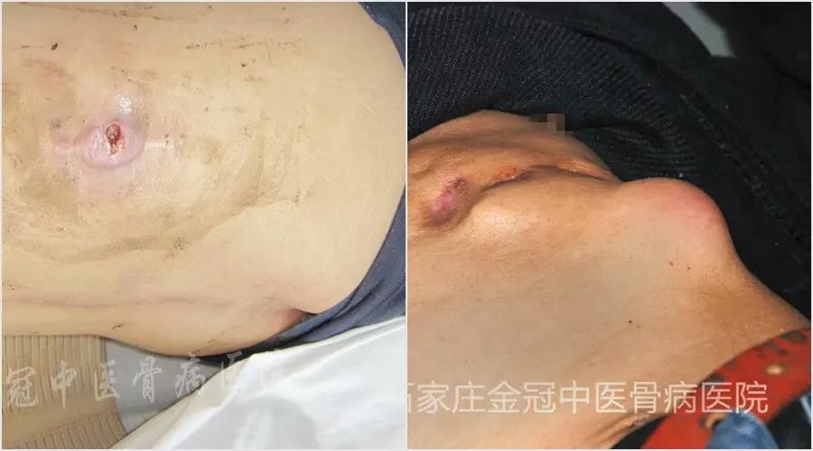 腰椎结核能治好吗该怎么治疗,八十岁老人腰椎结核能治好吗