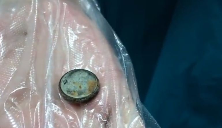 宝宝误吞纽扣电池多久有反应,宝宝误吞了纽扣电池怎么办