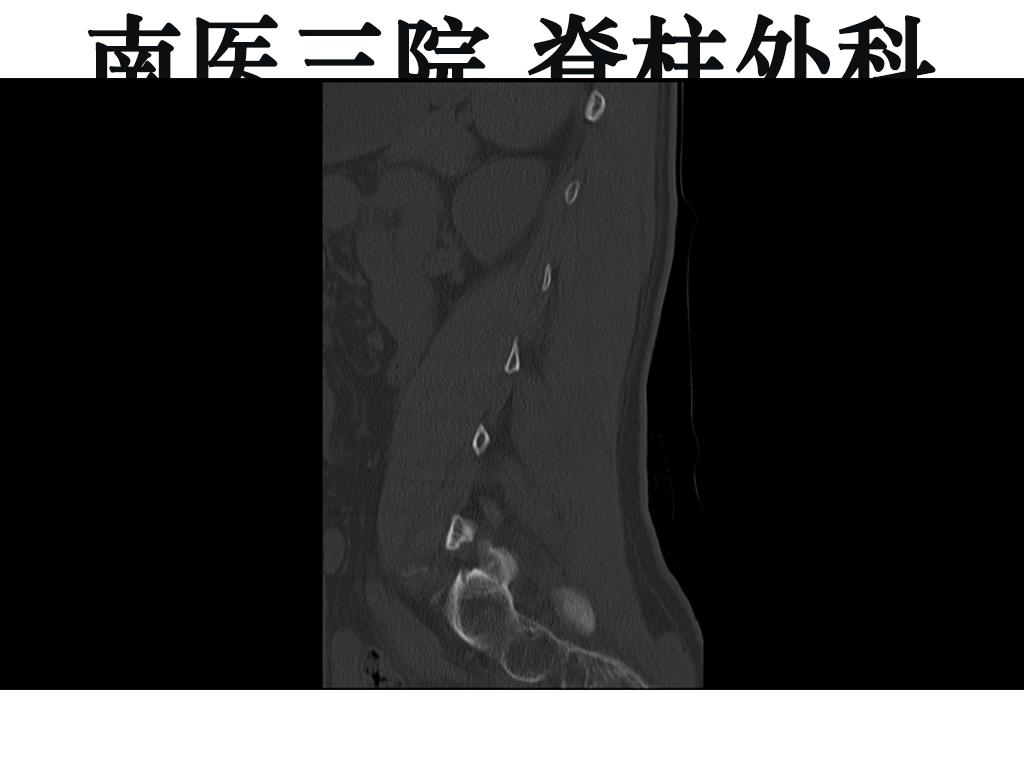峡部裂导致滑脱有没有痊愈的可能,青少年峡部裂做哪种手术最好