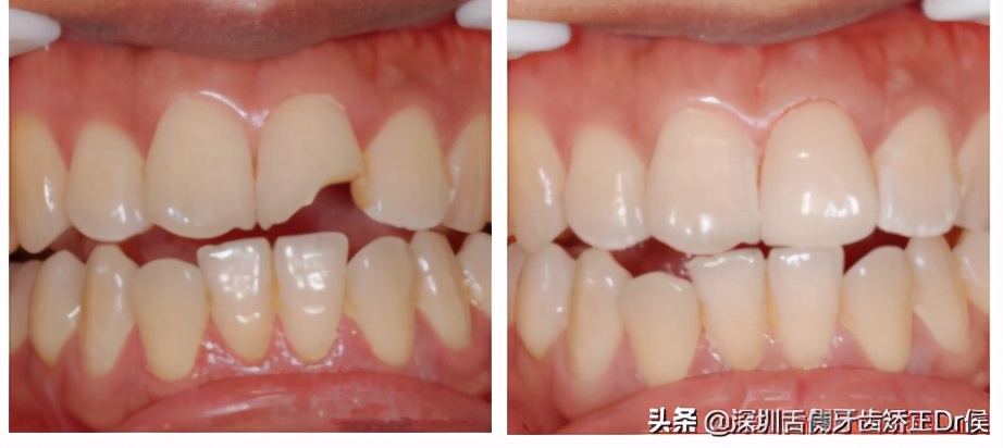 牙断了只剩牙根,牙断了怎么办