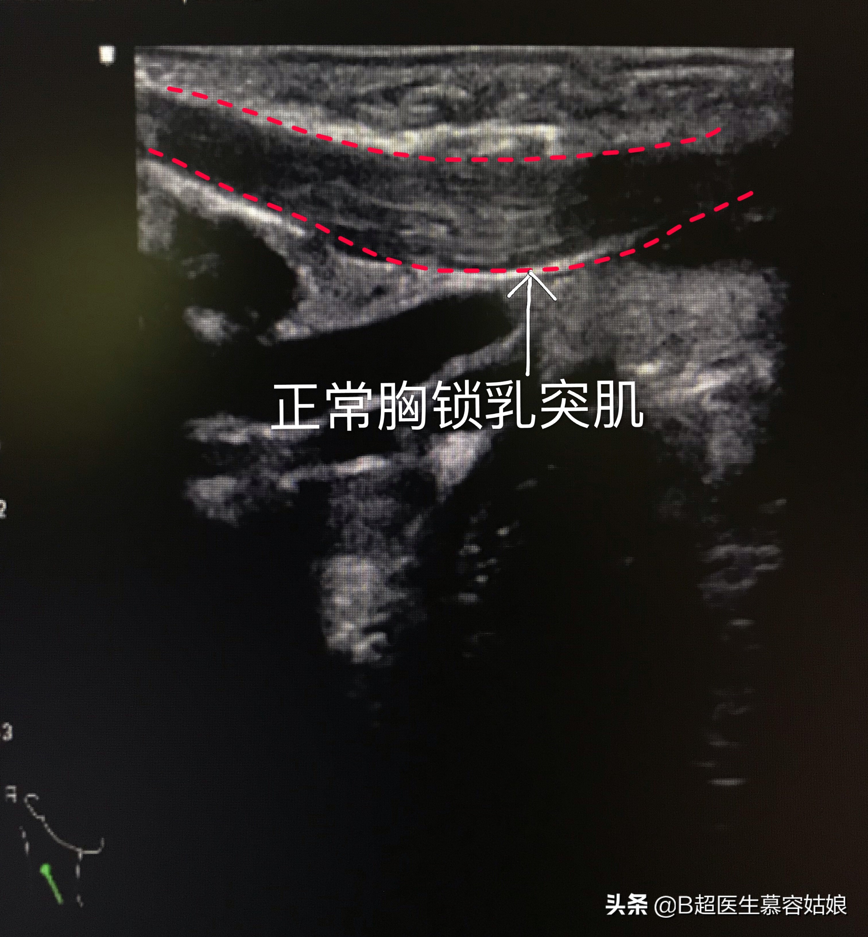 宝宝老是歪头后仰头,宝宝歪脖歪头怎么办