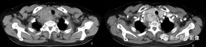 胸腺增生和纵隔肿瘤的区别和症状,纵隔胸腺肿瘤的常见临床症状表现