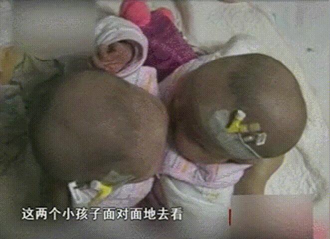 双胞胎坐骨连体成功案例,坐骨连体姐妹分离成功了吗