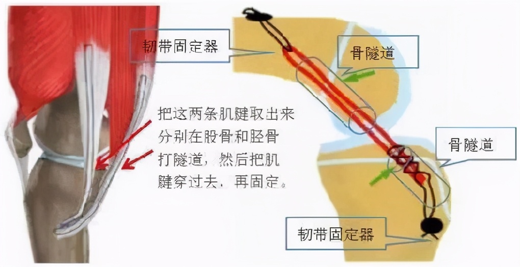前交叉韧带断裂手术费用大概多少,前交叉韧带断裂重建手术最佳时间