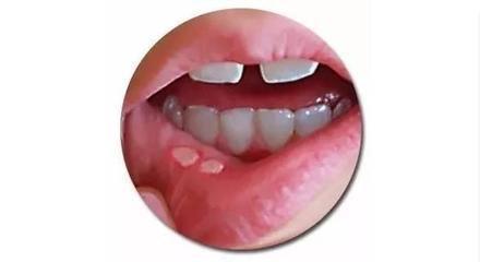 嘴上口腔起泡怎么办,嘴上长泡是上火还是疱疹