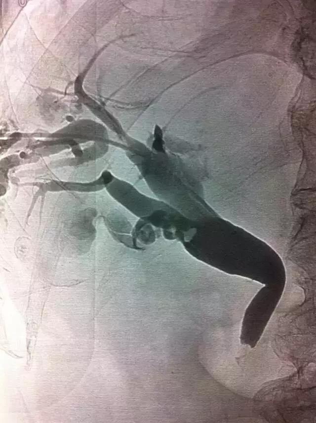 胆管结石和胆囊切除需要多长时间,胆管结石胆囊也切除手术后的饮食