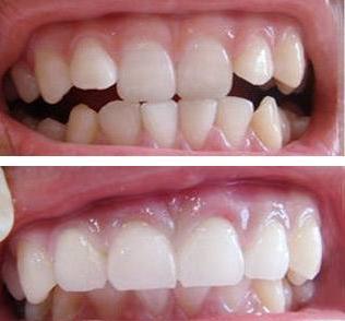 什么是美牙冠矫正,美牙冠对于龅牙效果好么