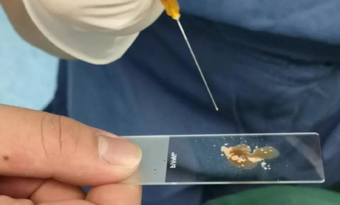 为什么肿瘤患者都拒绝做穿刺活检,穿刺活检恶性还能手术吗