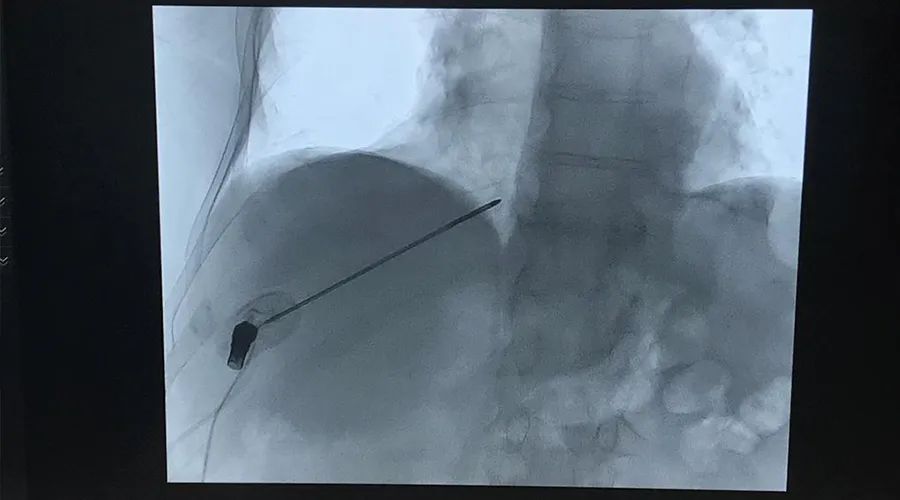 赛诺微射频消融仪,赛诺微射频消融
