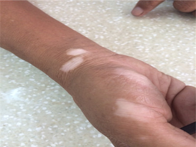 小伙子百般寻求良方，自己做自己的医生，却惨遭白癜风报复