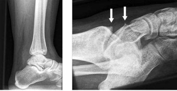 骨刺和骨质增生能治愈吗,骨刺其实不是病别再被忽悠了