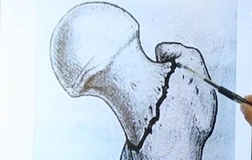 老年人腿粉碎性骨折手术要多少钱,老年人髋骨骨折后一年死亡率