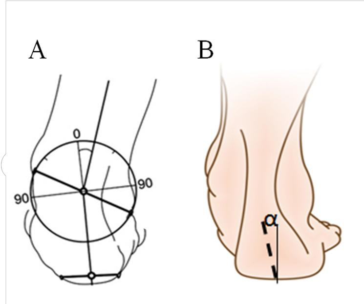 运动足外翻怎么矫正,运动引起脚大拇指外翻怎么矫正