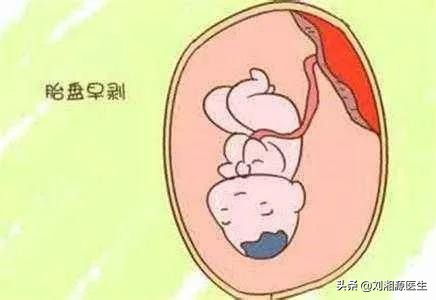 孕期反复流血跟免疫有关系吗,免疫相关不良妊娠答疑解惑