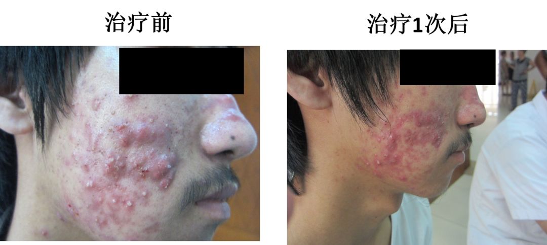 中医火针疗法教学视频,火针操作手法