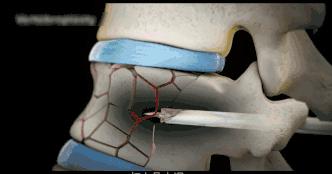 腰椎压缩骨折椎体成形术啥时候做,骨质疏松骨折椎体成形术操作步骤