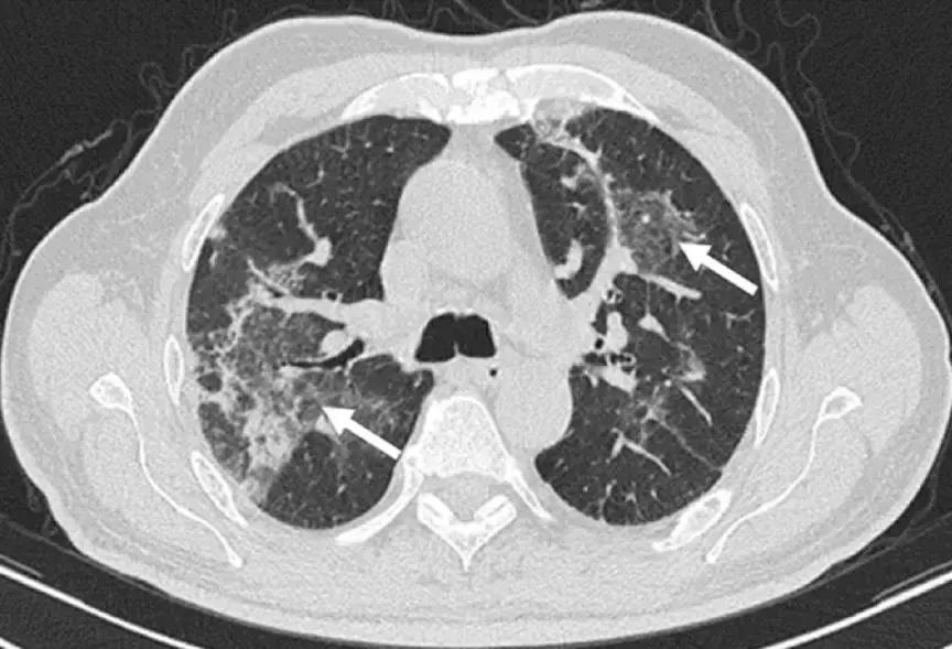 机化性肺炎平时应注意什么,机化性肺炎的正规治疗